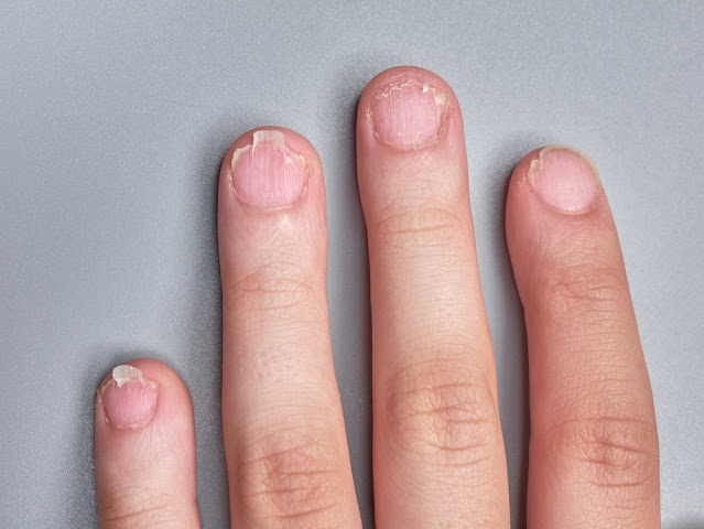 hand showcasing Weak brittle nails