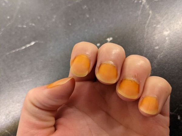 Turmeric stains on nails