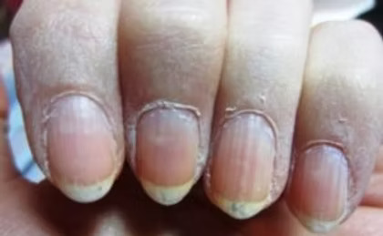 dry cracked cuticles